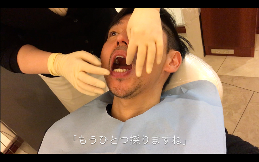 歯型取りの回数
