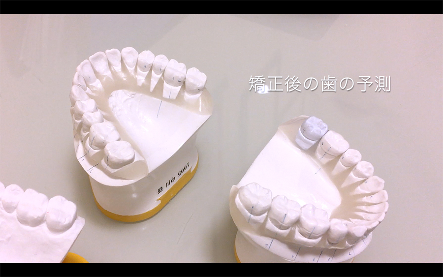 歯列矯正後の理想の歯の模型（セットアップ）