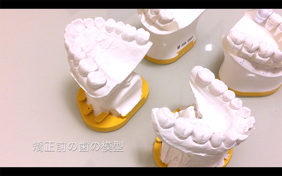 歯列矯正前の歯の模型