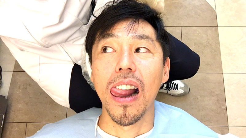 犬歯を削ると大変だよ！尖った八重歯を削った結果… | 歯列矯正した40代男のブログ