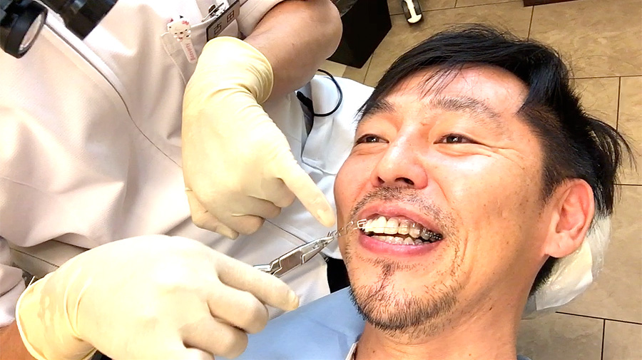 犬歯を削ると大変だよ！尖った八重歯を削った結果… | 歯列矯正した40代男のブログ