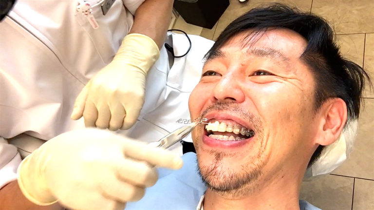 犬歯を削ると大変だよ！尖った八重歯を削った結果… | 歯列矯正した40代男のブログ