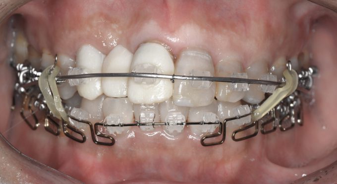 透明のカラーゴム｜歯列矯正のカラーゴムの着色を防ぐ方法