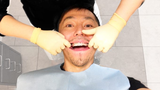 歯列矯正で口の歪みが治った 口元に悩んでる人必見 画像あり