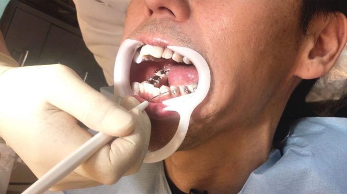 歯列矯正装置を装着する場所を決める