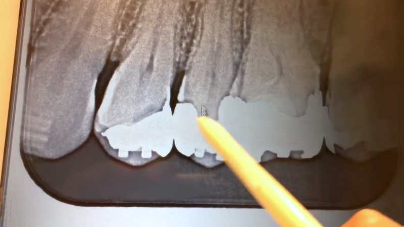 歯列矯正中に虫歯を確認するために撮影したレントゲン画像