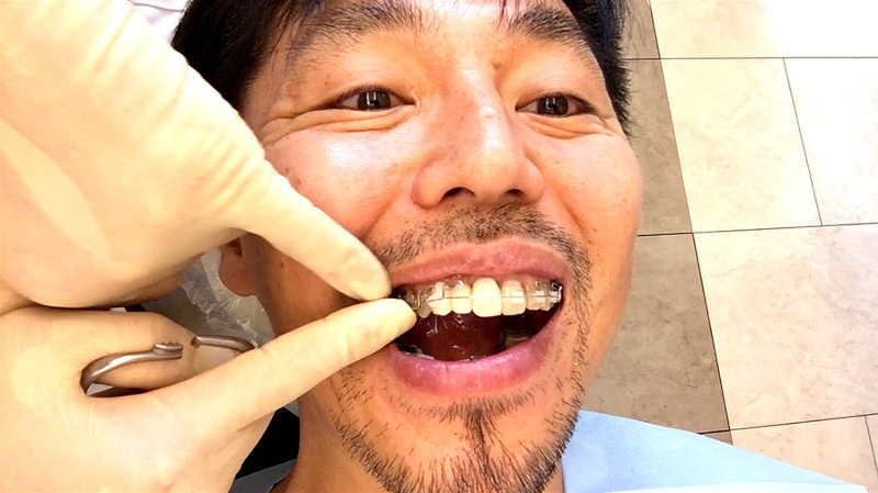 差し歯に取り付けられた歯列矯正器具