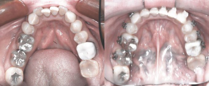 歯列矯正前と歯列矯正１年後の下の歯の変化