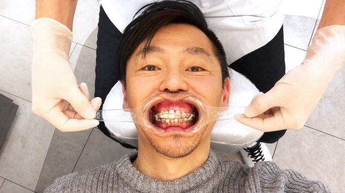 【非抜歯矯正ブログ】健康な歯を抜きたくなかった理由【体験談】