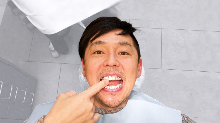 【虫歯】銀歯以外の白い被せ物でも保険治療ができる【条件あり】