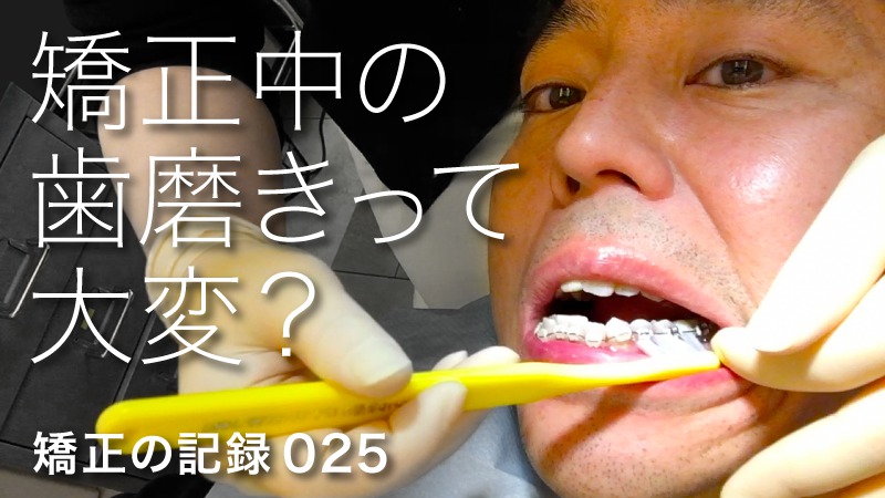 歯列矯正中の歯磨きのやり方 歯ブラシ 歯間ブラシ フロス 動画有
