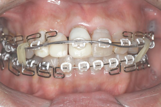 歯列矯正1年経過後の歯並び