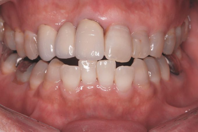 歯列矯正前の叢生の歯並び