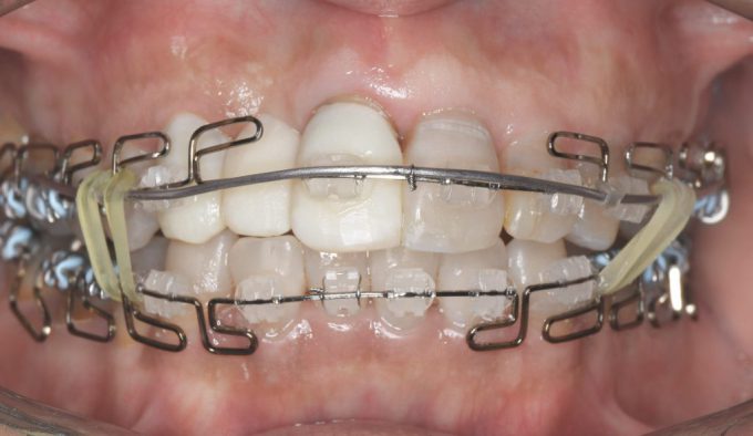歯列矯正4ヶ月経過後の歯並びの変化
