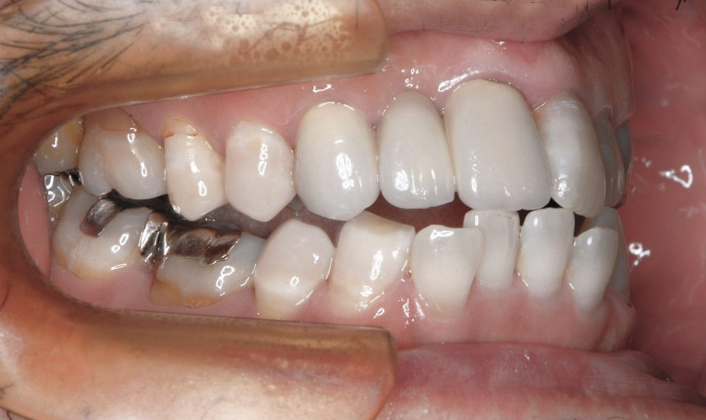 正しい噛み合わせとは一体どんな位置 歯列矯正して分かった本当のコト