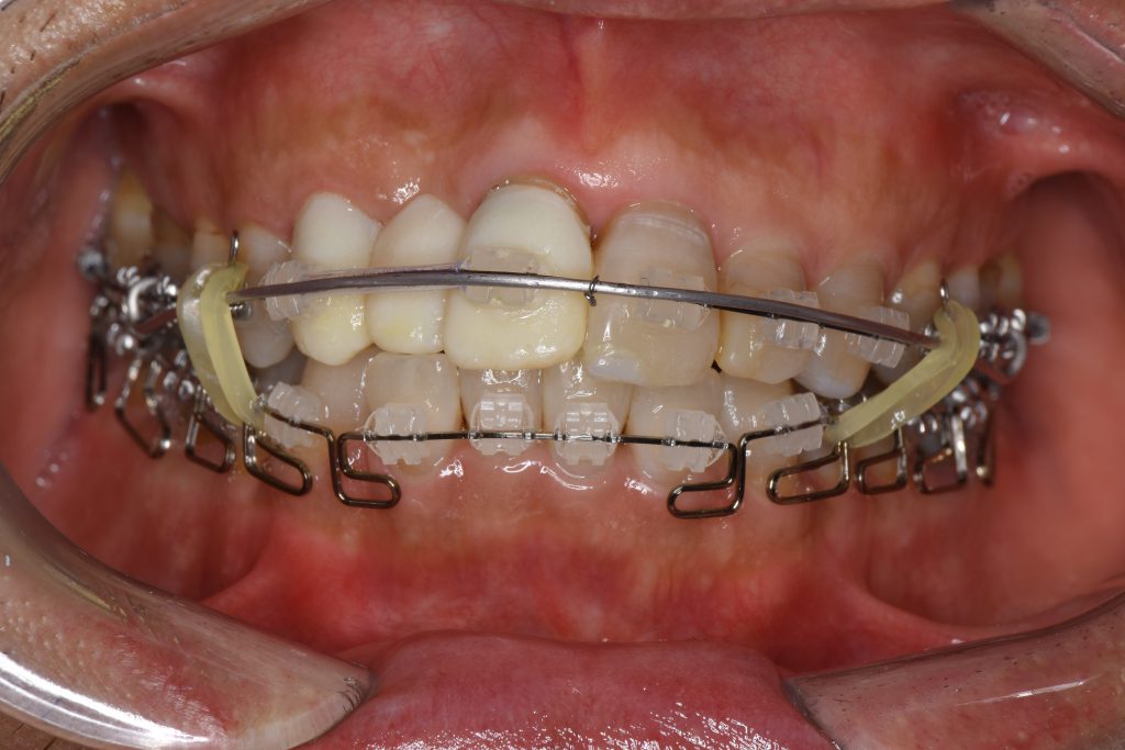 歯列矯正1年で起きた変化① 歯並びがキレイになった