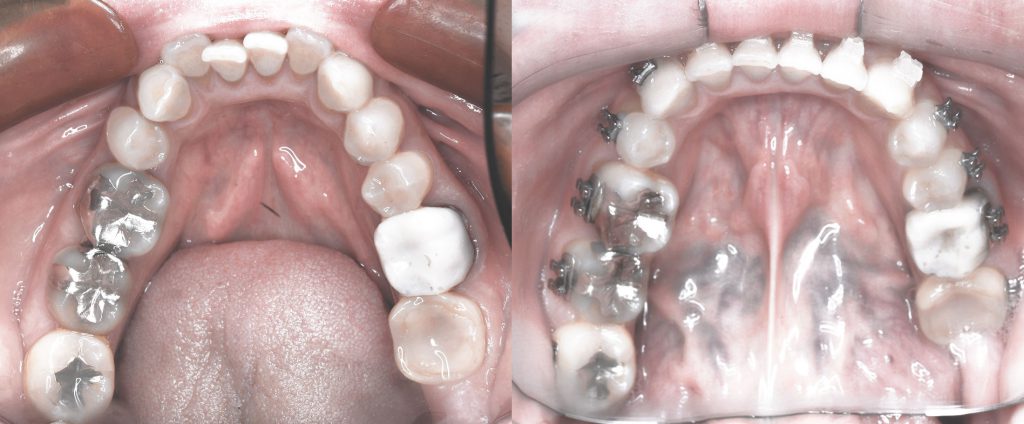 歯列矯正１年 下の歯の変化｜比較画像