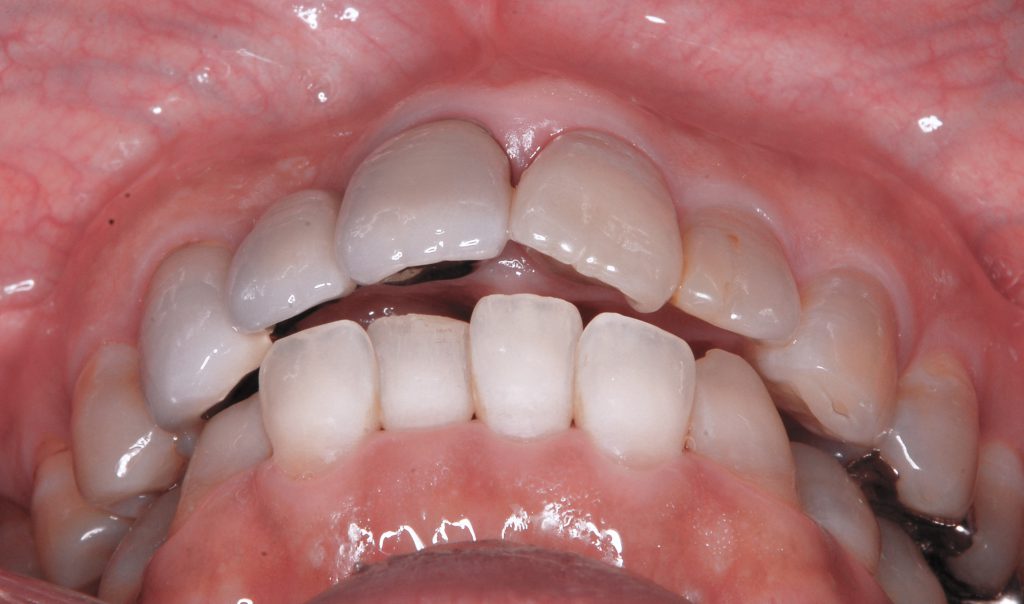 出っ歯の変化：噛み合わせ｜歯列矯正前