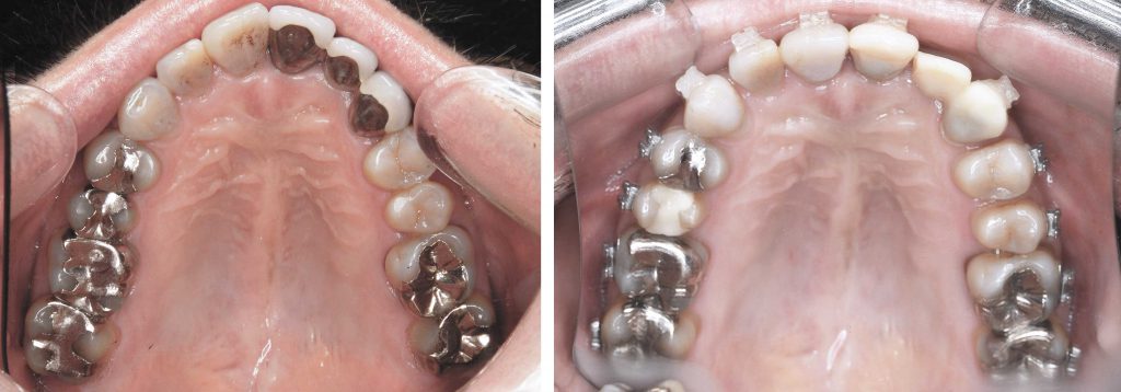 歯列矯正1年で起きた変化① 歯並びがキレイになった｜上の歯の出っ歯