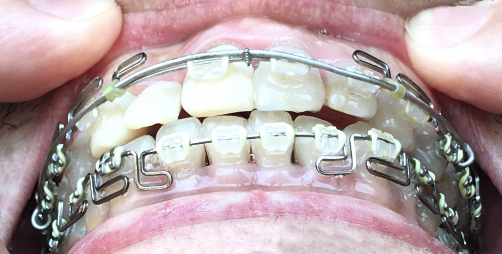 出っ歯の変化：噛み合わせ｜歯列矯正１年後