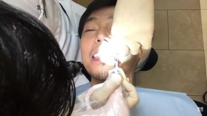 電動の注射器で歯茎に麻酔注射をされる男性