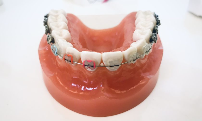 歯列矯正ワイヤーを取り付けた歯の模型