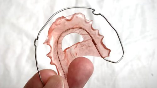 リテーナーの種類とそれぞれの違いやメリットについて歯医者さんに聞いてみた | 歯列矯正した40代男のブログ