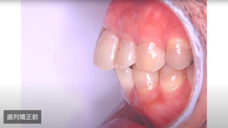 歯列矯正前の出歯。左横から