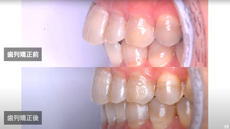 歯列矯正前の出っ歯が、歯列矯正後に解消した比較写真