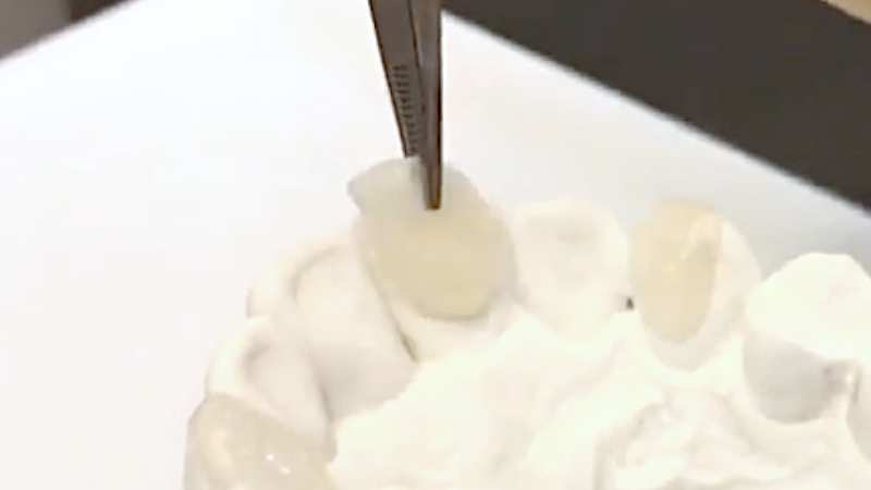 前歯が当たらない噛み合わせを治す、歯の裏につけ爪のような樹脂を貼り付ける方法