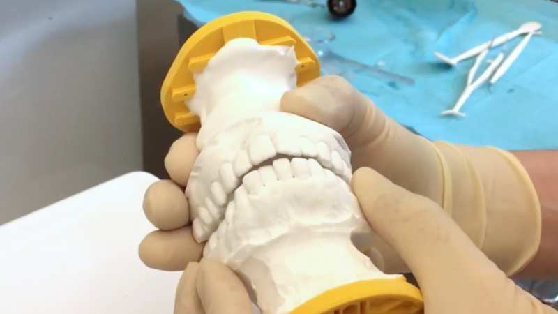 前歯が当たらない噛み合わせの歯の模型