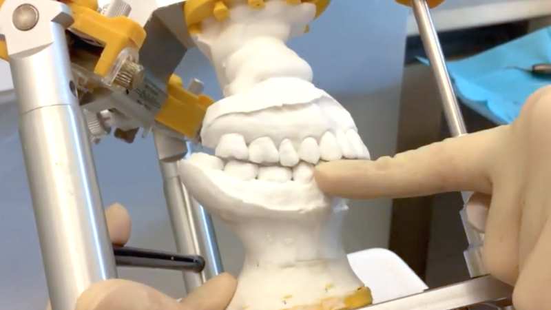 奥歯が迫り上がっている歯列の模型