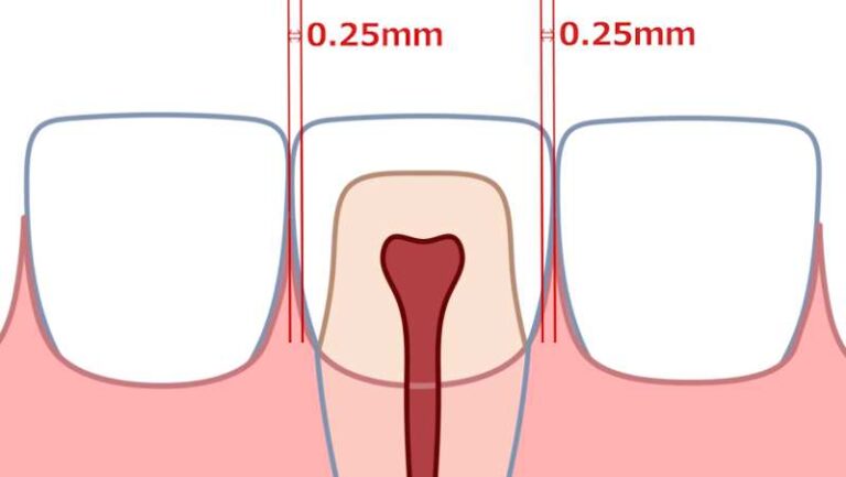 前歯の裏に下の歯が当たる原因は 。削るのはやめた方がいい | 歯列矯正した40代男のブログ